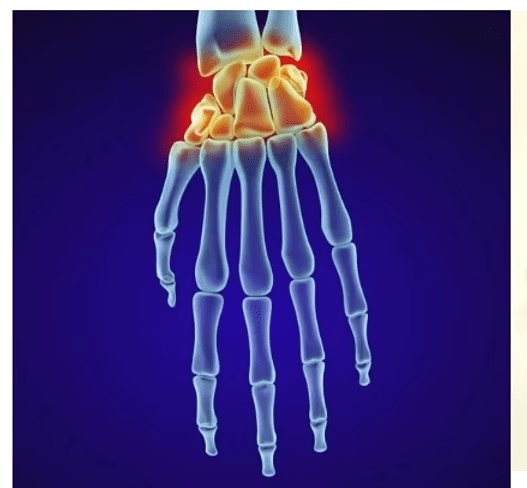Carpal tunnel Syndrome 2 image 1