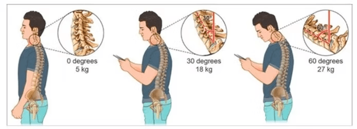 Text Neck Syndrome 1 image 11