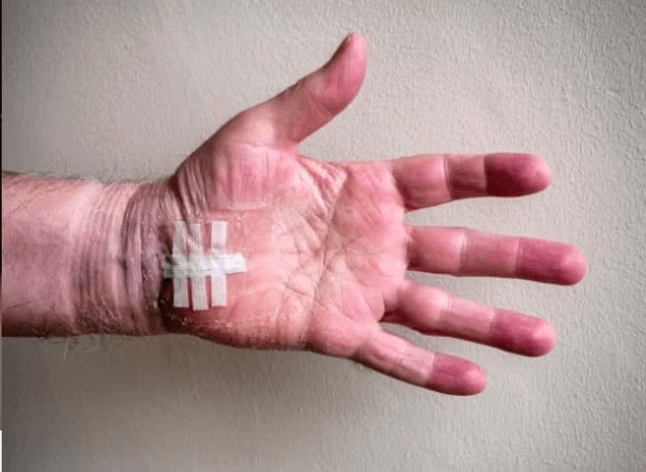 Carpal tunnel Syndrome 4 image 3