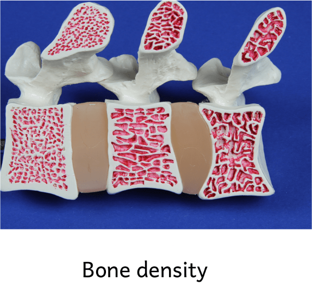 Brittle Bones? 2 image 37