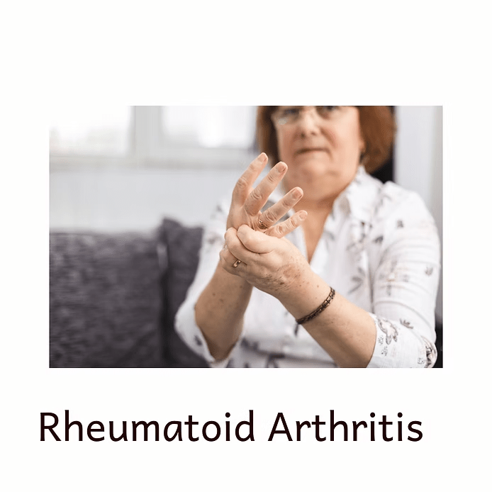 Rheumatoid Arthritis -brief overview 1 image 44