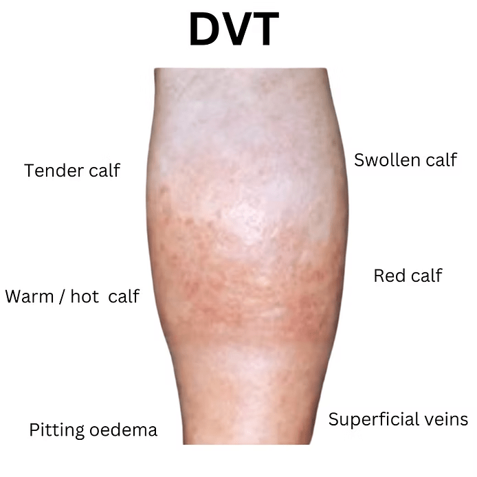 DVT 1 image 1