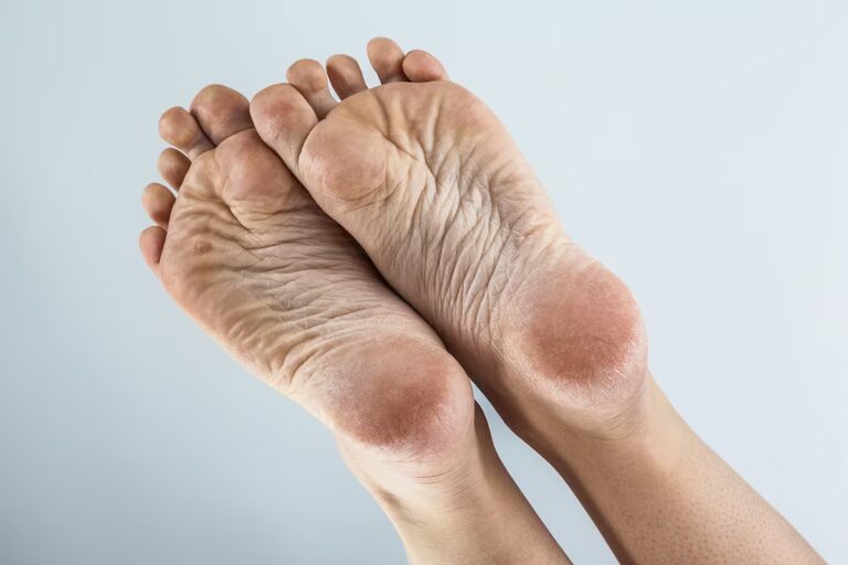 Corns & Calluses - Physiozen