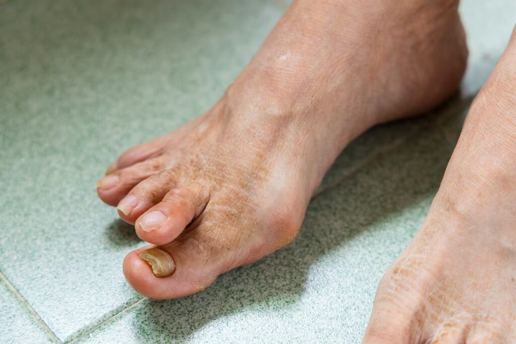 Fungal Nails Onychomycosis