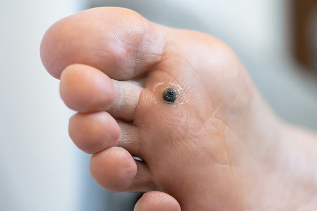 Verruca Plantar Warts